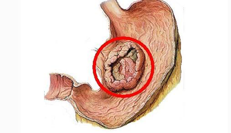 胃癌细胞